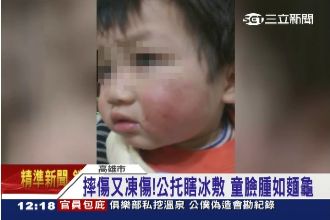 公托中心亂冰敷　童臉凍傷如「麵龜」