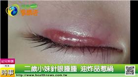 健康醫療網,二歲小妹針眼腫腫 油炸品惹禍