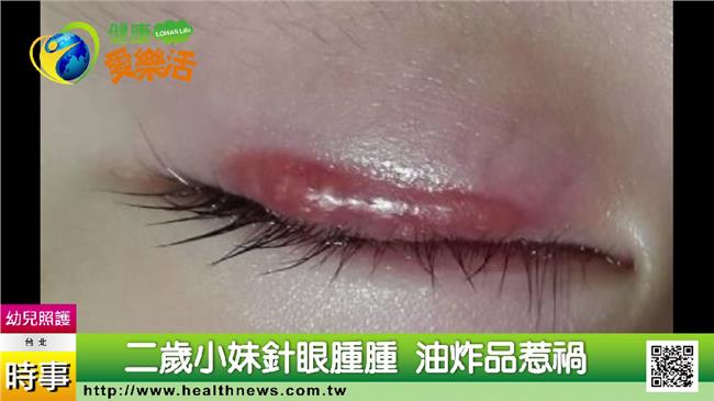 小朋友常長針眼　都是這些食物惹的禍