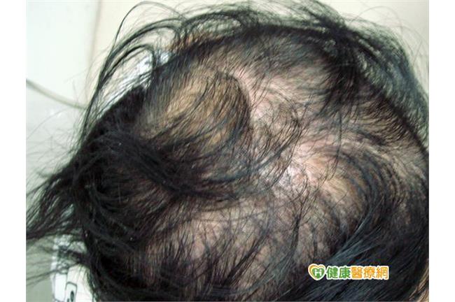 為什麼一直掉頭髮？原因竟然是…
