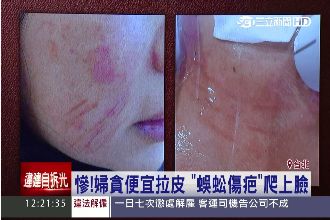 慘！婦貪便宜拉皮「蜈蚣傷疤」爬上臉