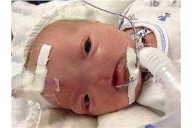 無鼻男孩／翻攝自Eli's Story臉書、英國每日郵報