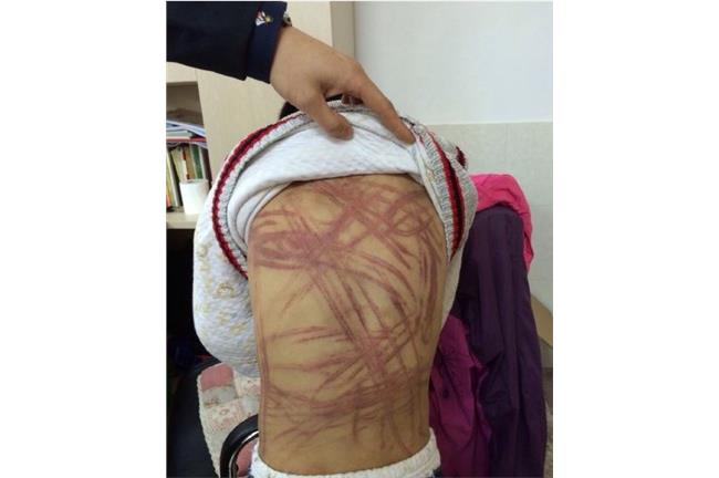 殘忍！男童疑遭養父母鞭至百條血痕