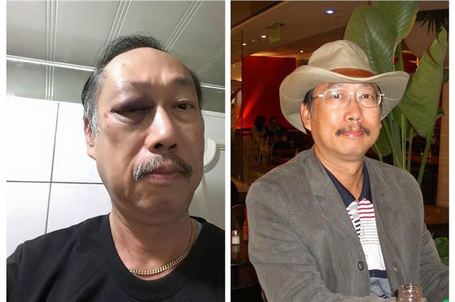 「要打瞎我！」吳家誠酒醒上傳腫眼照