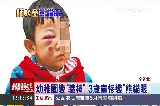 老師揮棒不慎重擊　3歲童慘變熊貓眼