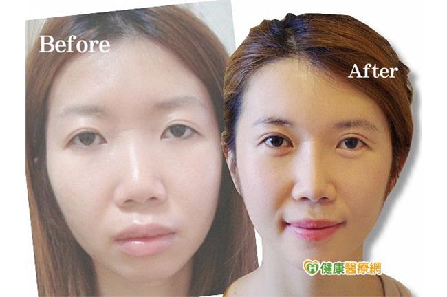 臉部補脂手術　玻尿酸、自體脂肪差在…
