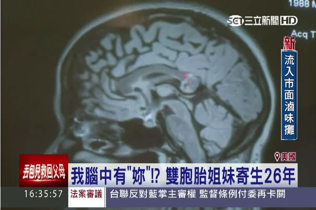 印度女頭痛欲裂　竟是胚胎在腦中作祟