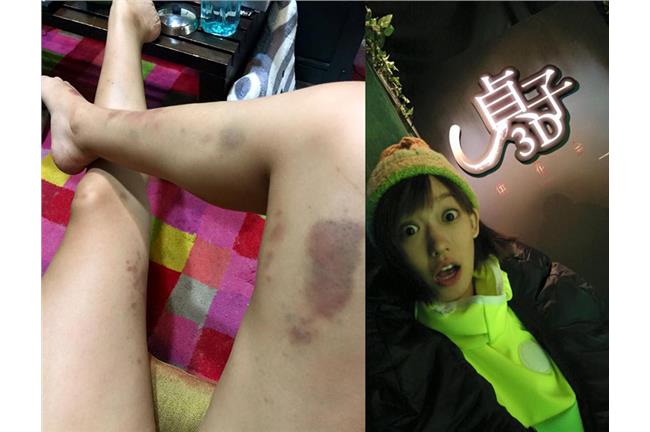 孟耿如被鬼揍？雙腿黑整塊還喊爽！