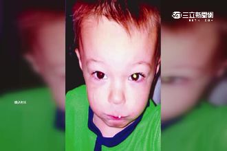 幫兒拍照「瞳孔反白」　原來是眼癌！