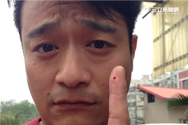 花枝、透抽分不清？林佑星遭花枝咬傷