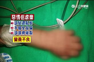 惡情侶領養三歲女童　狠心施虐全身傷