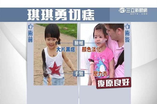 腿肉移植手臂　罕病琪琪勇敢切除黑痣