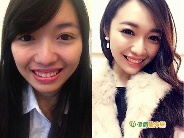 一個午休時間　打造超自信完美微笑