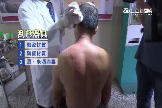 男刮痧細菌感染　住院兩星期險死