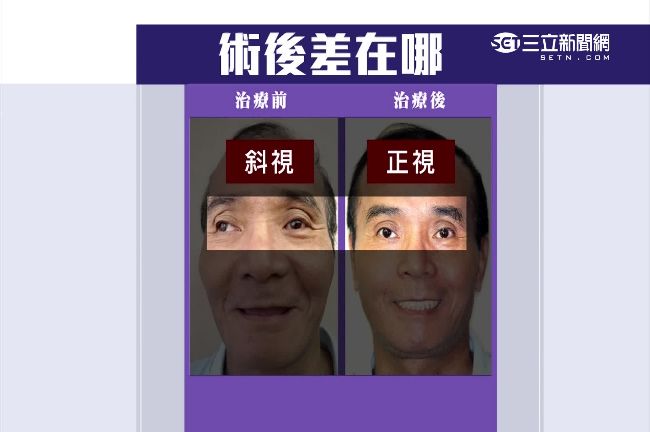 廣告修圖修太大？整牙竟連斜視都好了