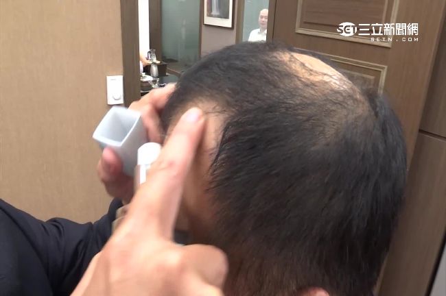 更快擺脫禿頭！研究：三週喚回毛髮