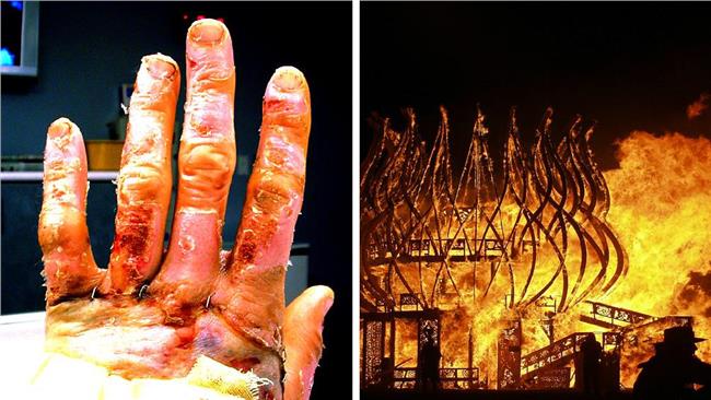 嘜相害！4個流傳N百年的燙傷謠言