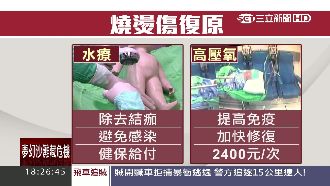 燒傷「高壓氧」治療　療程昂貴難負擔