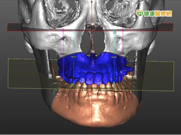 3D列印技術　可望成為顱顏手術主流