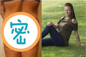 組圖 提臀手術留疤痕/翻攝自每日郵報