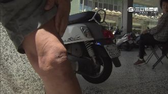 無退休金當醫藥費　斷腿退休警苦難耐
