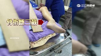 恐怖！民眾玩公園設施　腿竟斷成三截
