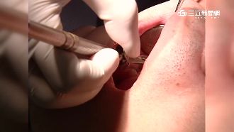 咬合時有觸電感？原來竟是＿惹的禍