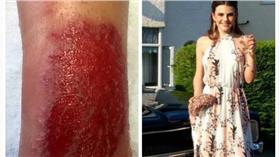 印度彩繪紋身燒傷（組圖／翻攝自英國《鏡報》和Mary Bates臉書）