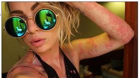 牛皮癬,皮膚病/每日郵報