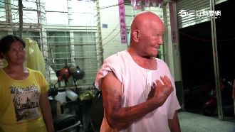 登革熱藥劑噴到皮膚焦黑？　里長喊冤