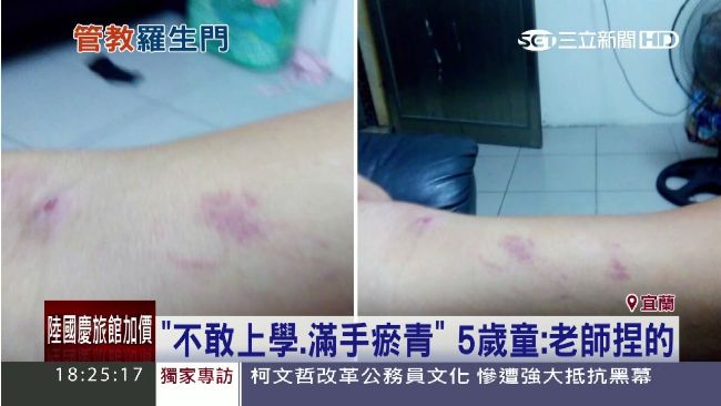 滿手瘀青嚇到不敢上學　童指老師捏的