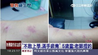 滿手瘀青嚇到不敢上學　童指老師捏的