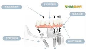 創造微笑曲線　植牙還能變年輕！／健康醫療網