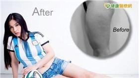 運動型粗象腿少女　水刀微粹脂抽脂大蛻變／健康醫療網