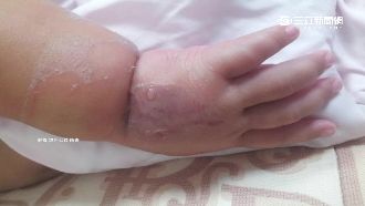 醫療疏失？男嬰住院漏針　手背紅腫潰