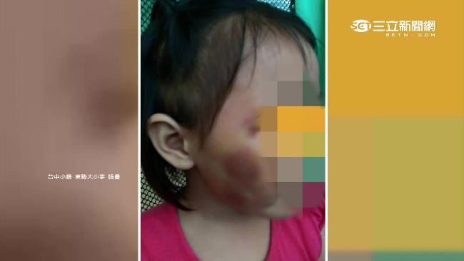 4歲女童遭掌摑臉紅腫　疑遭繼父虐待