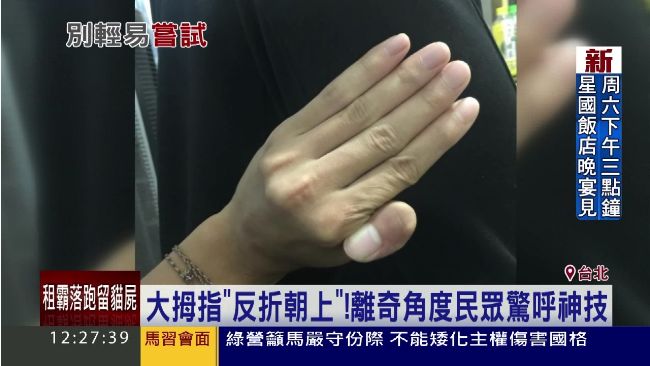 這大拇指太離奇！反折角度讓民眾驚呼