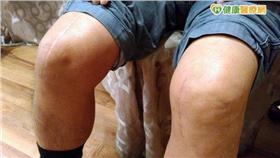 機械手臂換膝關節　當晚就能行走／健康醫療網