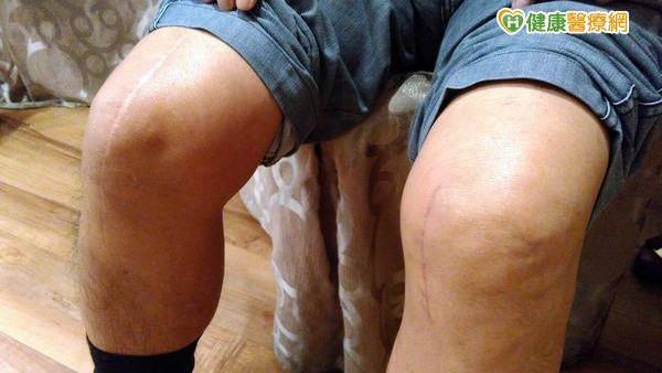 機械手臂換膝關節　當晚就能行走