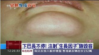 想要尖下巴！陸女注射生長因子變戽斗