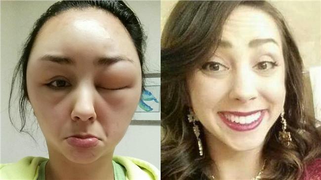 女孩用了這個大過敏　變身腫眼外星人