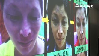 抗生素混中藥吃　女子臉變「納美人」
