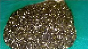 膽結石－圖／翻攝自《每日郵報》