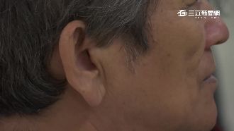 耳垂上有橫紋的人　易罹患這些疾病