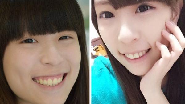 不再低頭抿嘴！她這樣解決少女的煩惱