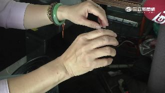 機車遭潑強鹼　咖啡廳老闆娘手掌灼傷