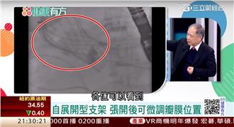 主動脈瓣膜狹窄　免開心也能換？