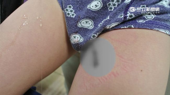 科工館恐怖鋼釘椅　狠刮4歲童大腿臀