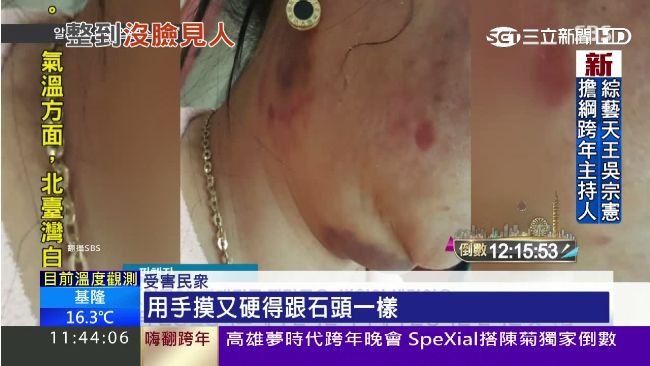 工業矽膠當肉毒桿菌　女毀容皮膚壞死