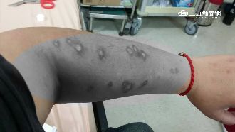 車臨停竟遭噴白粉　駕駛皮膚紅腫潰爛